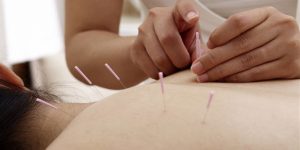 Como é a Acupuntura e Como Ela Pode Te Ajudar