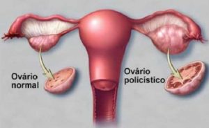 SOP - O Que É Síndrome do Ovário Policístico