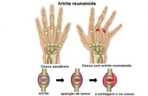 Artrite: Dicas Que Vão Te Ajudar A Diminuir a Dor
