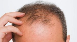 Tratamento Para Calvície Masculina Padrão