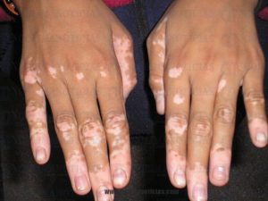 Vitiligo e Perda Da Cor Da Pele