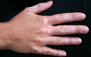 Vitiligo e Perda Da Cor Da Pele