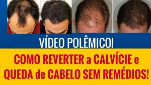 como vencer a calvicie