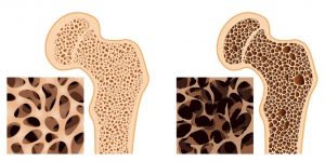 Osteoporose