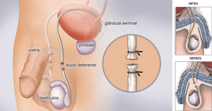 vasectomia